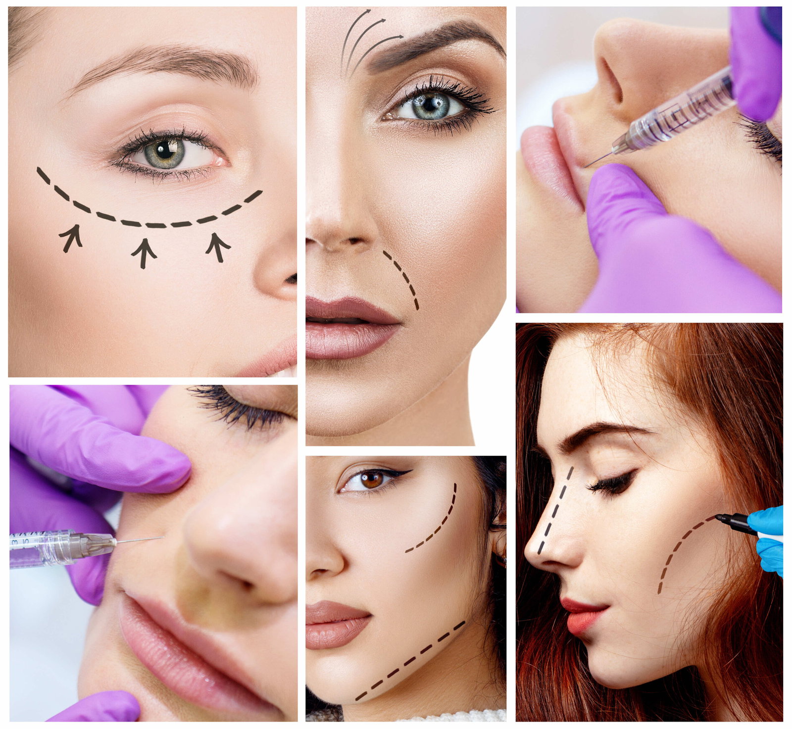 Dermal filler procedure zones diagram